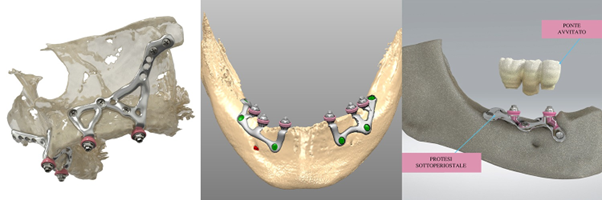 Innovazioni in implantologia: come l’All-on-4 sta cambiando la vita dei pazienti senza denti